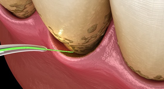 Illustration of laser periodontal treatment