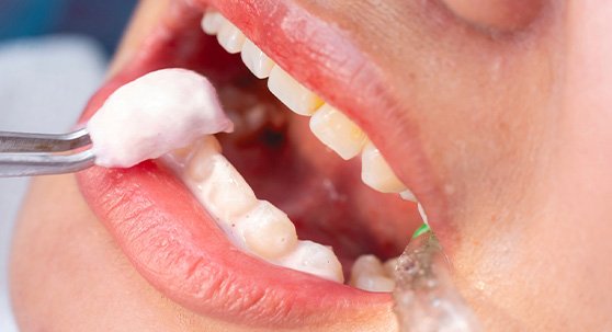 Close up of a mouth with foam fluoride being placed on enamel with cotton swab