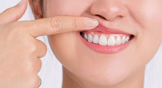Woman showing off her gums
