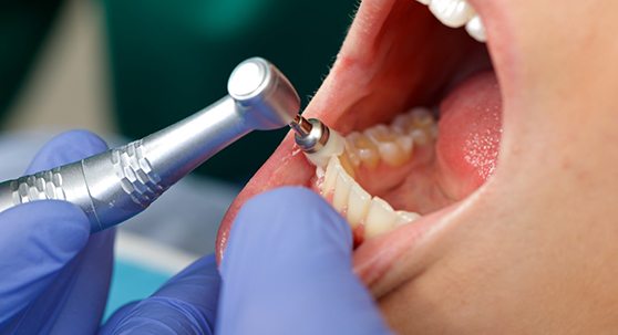 A woman getting a dental cleaning