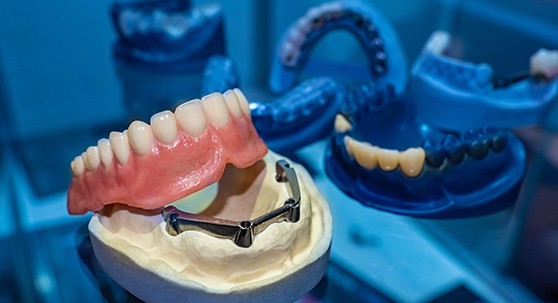 Example of implant dentures in Lakewood