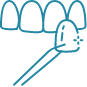 Animated veneer being placed over a tooth icon