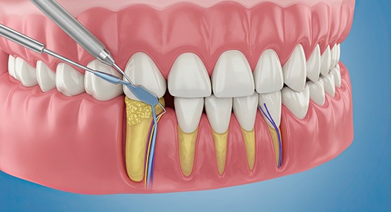 A CGI of a scaling and root planing procedure