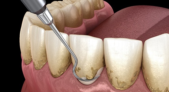 A CGI of teeth being cleaned during scaling and root planing