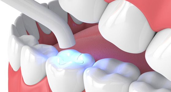 a 3D illustration of a tooth-colored filling
