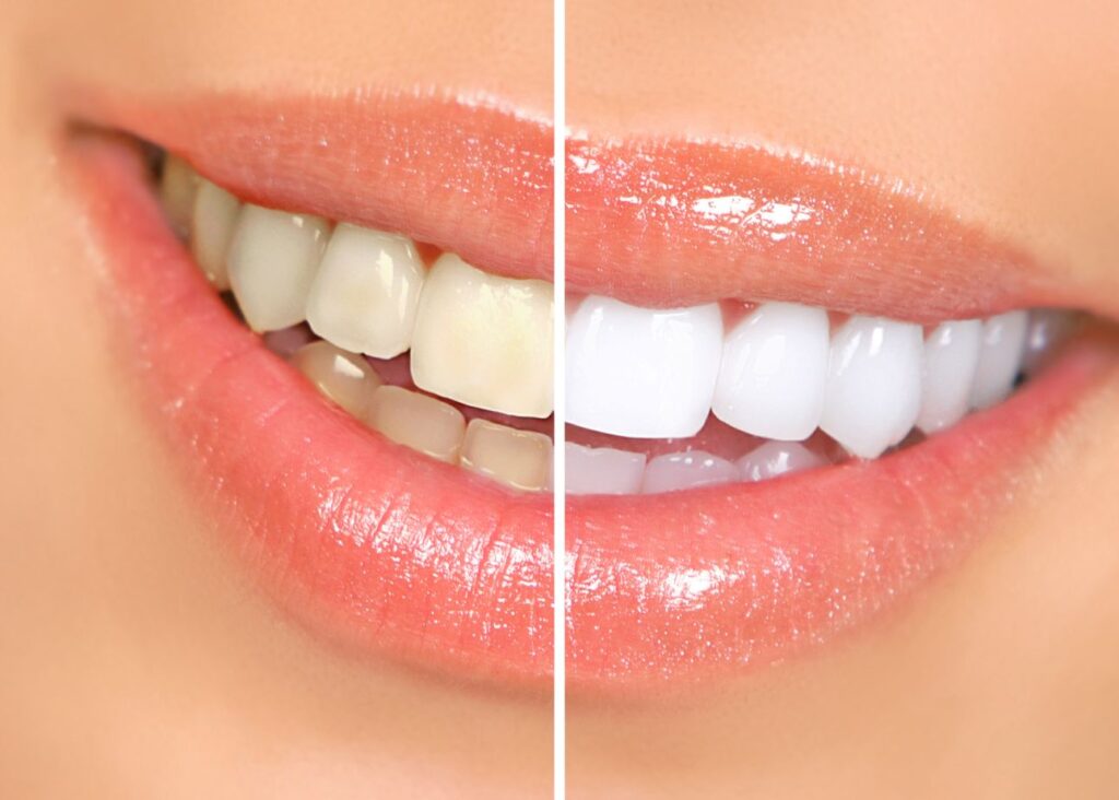 Closeup of woman's smile halved to show teeth whitening results