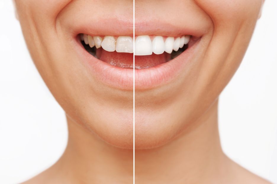 A woman’s smile before and after veneers.